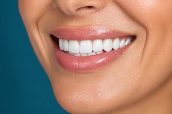 Porcelain veneers